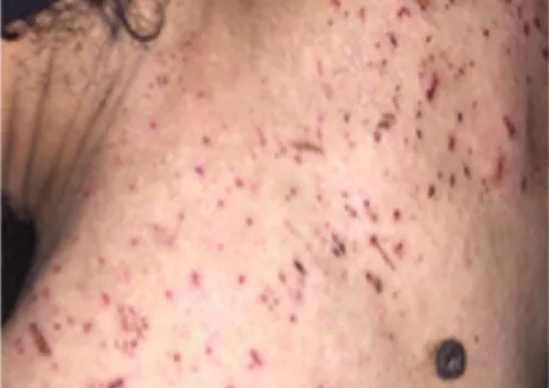 Pediculosis corporis