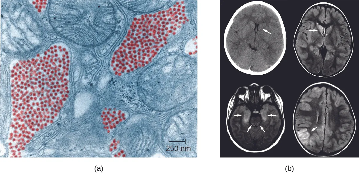 a) electron micrograph showing small red dots next to larger cellular structures. B) brain scans with arrows pointing to dark regions in the brain.