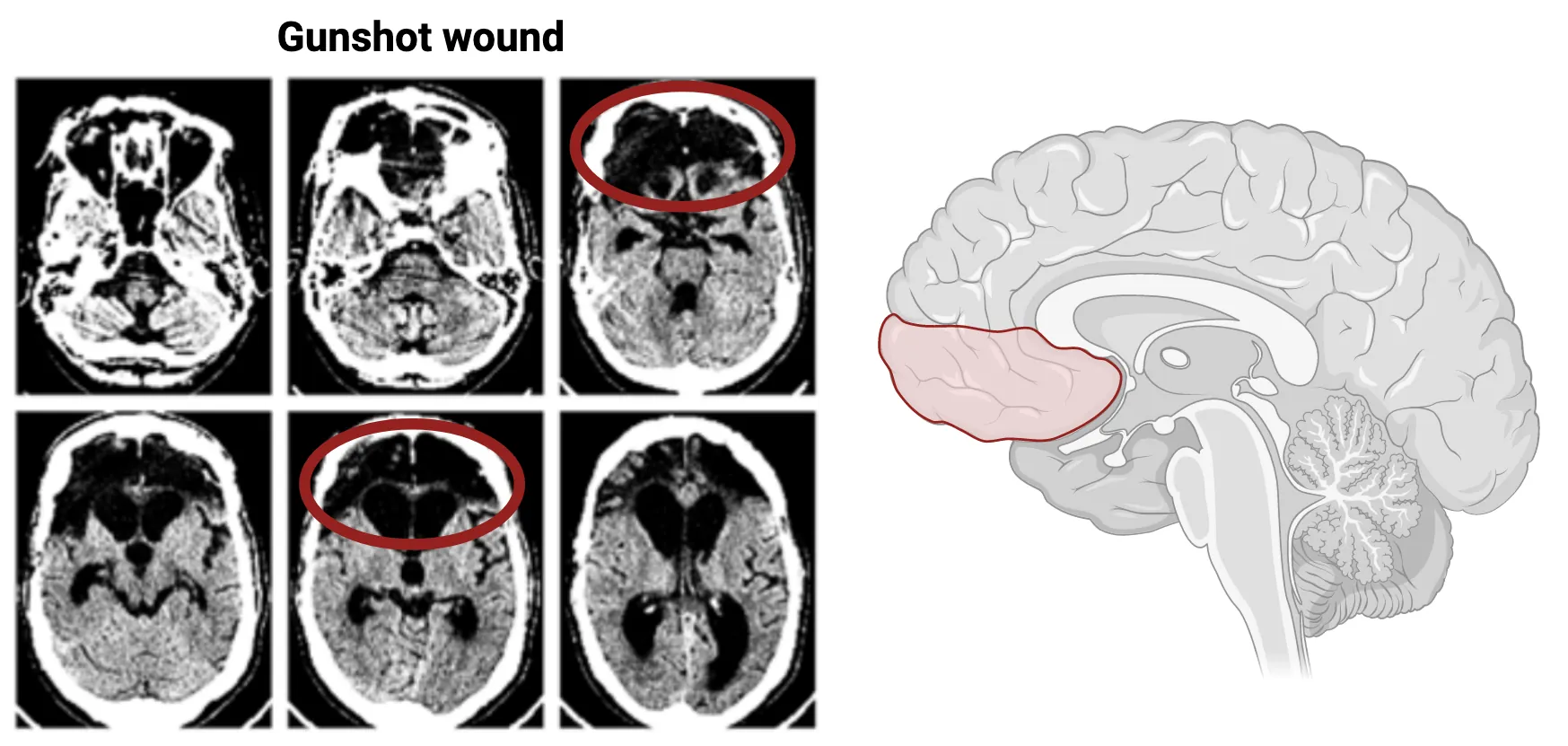 Brain images showing large empty spot where ventromedial prefrontal cortex should be. Plus a cartoon diagram of the human brain with the vmPPC highlighted