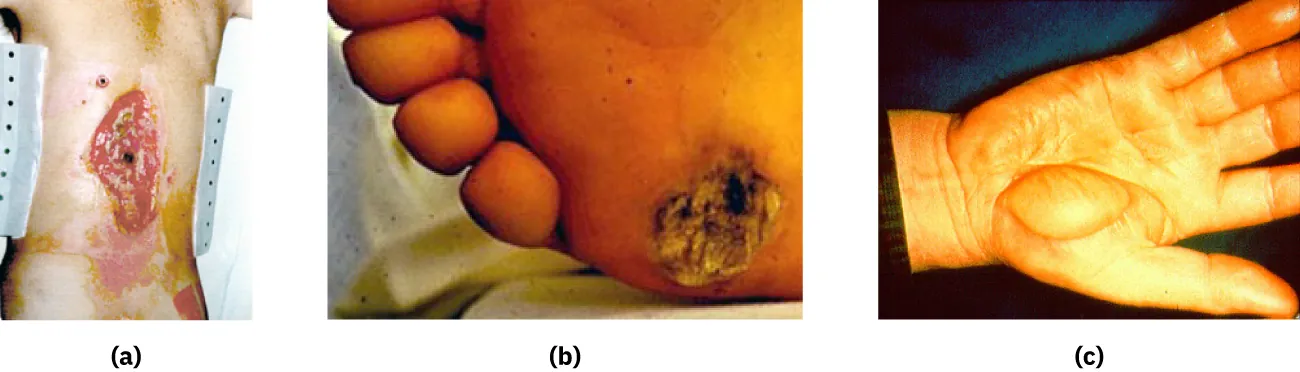 Images showing various electrical burns: (a) electrical burn entry wound; (b) electrical burn exit wound; (c) electrical burn on the hand.