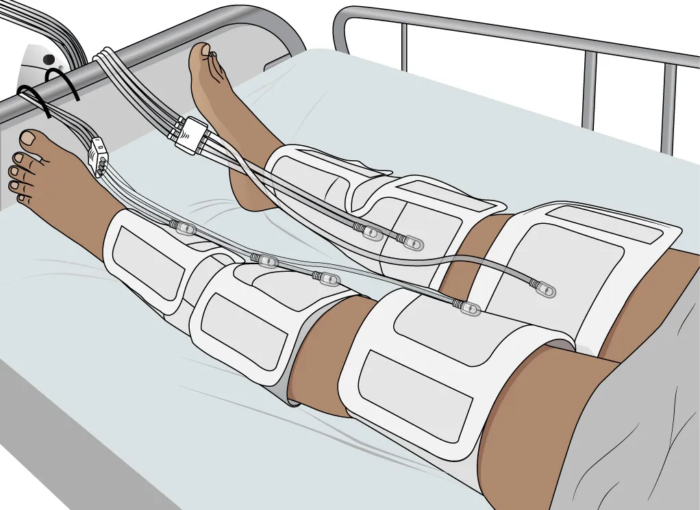 An illustration shows a patient’s legs wrapped in compression devices while lying in a hospital bed.