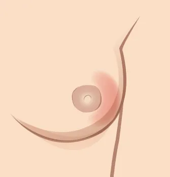 Image of breast with red area visible around the nipple.