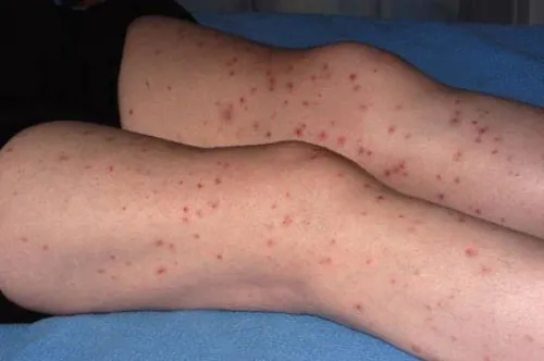 Close-up of a person's legs showing numerous red, raised spots scattered across the skin, indicative of a widespread rash or skin irritation, possibly urticaria or folliculitis, against a blue background.