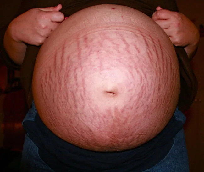 A photograph of a pregnant abdomen with stretch marks scattered across the entire bottom portion. The lines appear as read marks.