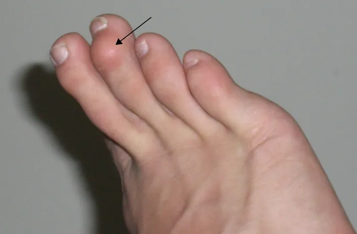 The image displays a close-up of a foot with the second toe exhibiting an abnormal bend at the middle joint, characteristic of a condition known as hammertoe.