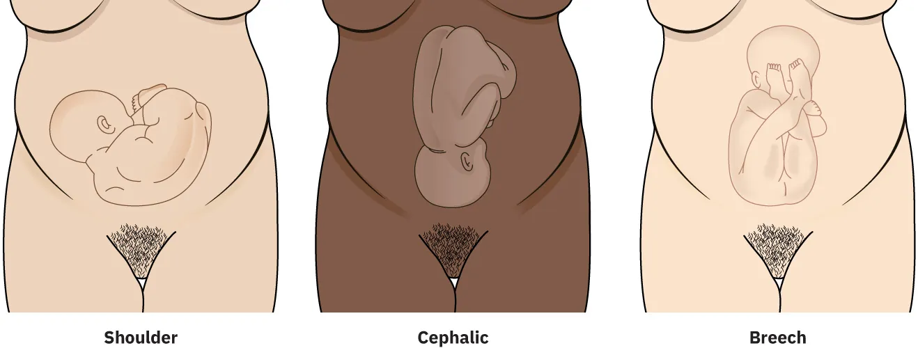 Diagram of fetal presentation showing shoulder, cephalic, and breech.