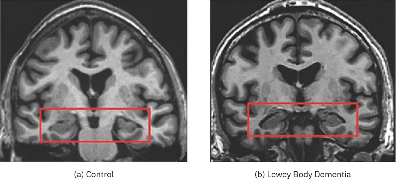 (a) An image shows a healthy brain with areas of tissue and a box outlining the hippocampus. (b) An image shows a brain with Lewy body dementia, where the hippocampus is smaller than the first image.