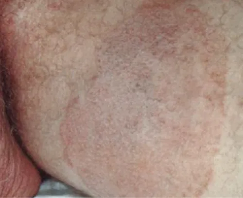 A color photograph showing tinea cruris