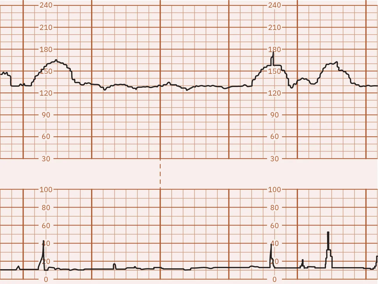 Fetal monitor tracing graphic depicting a reactive NST. Top strip indicates spikes at same times lower strip indicates spikes.