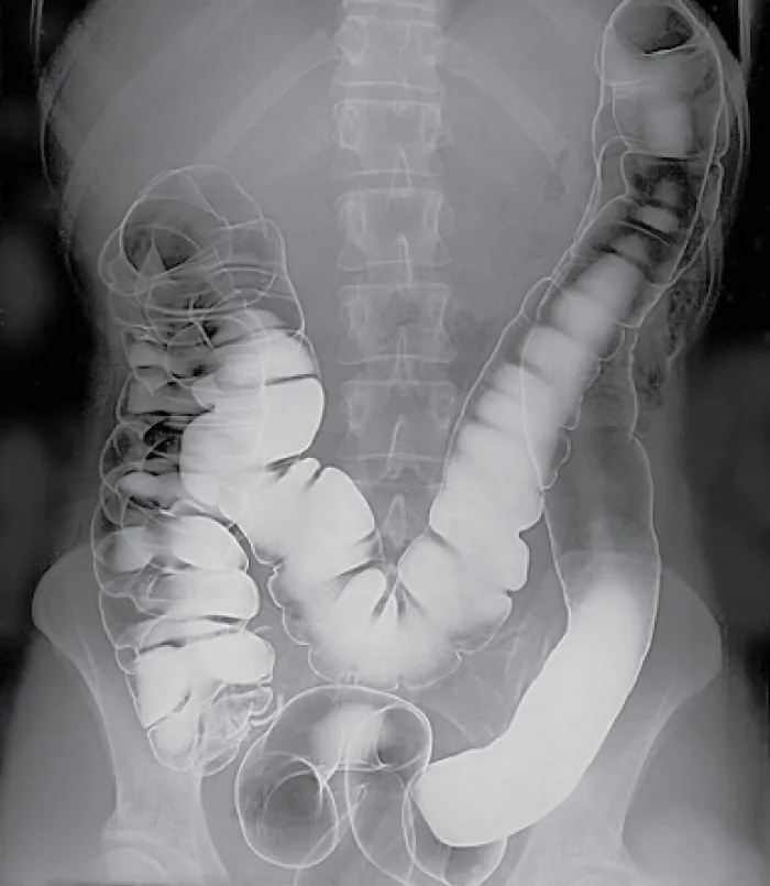Image of colon in x-ray coated with barium.