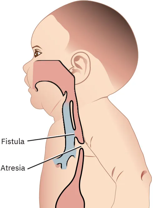 Illustration showing a profile of an infant's head and neck, with areas highlighted to represent an esophageal atresia and tracheoesophageal fistula.