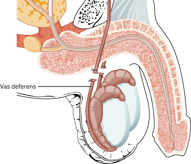 Image of both the vas deferens cut and tied off in the male reproductive organs.