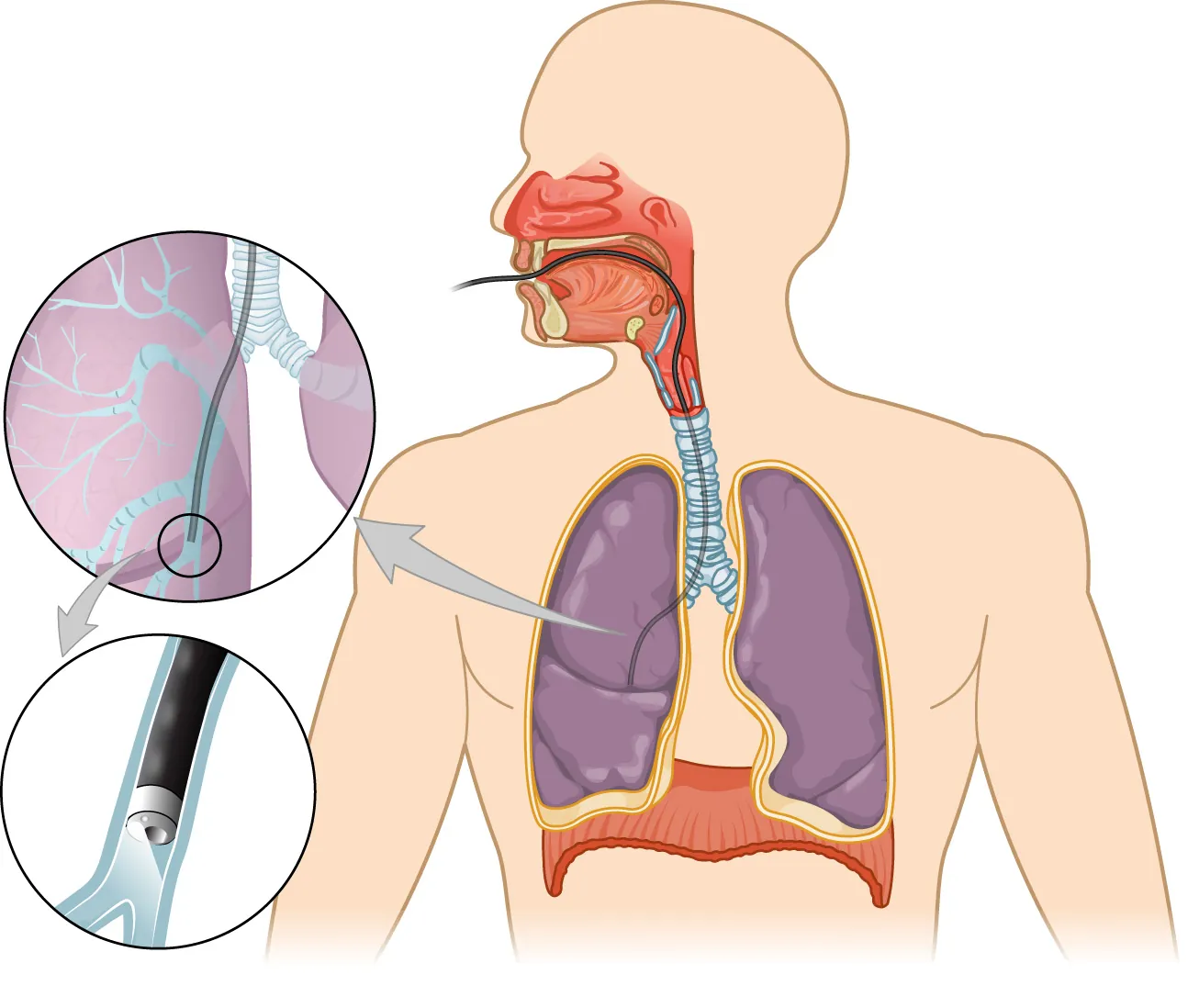 Diagram showing bronchoscope inserted through mouth into lungs.
