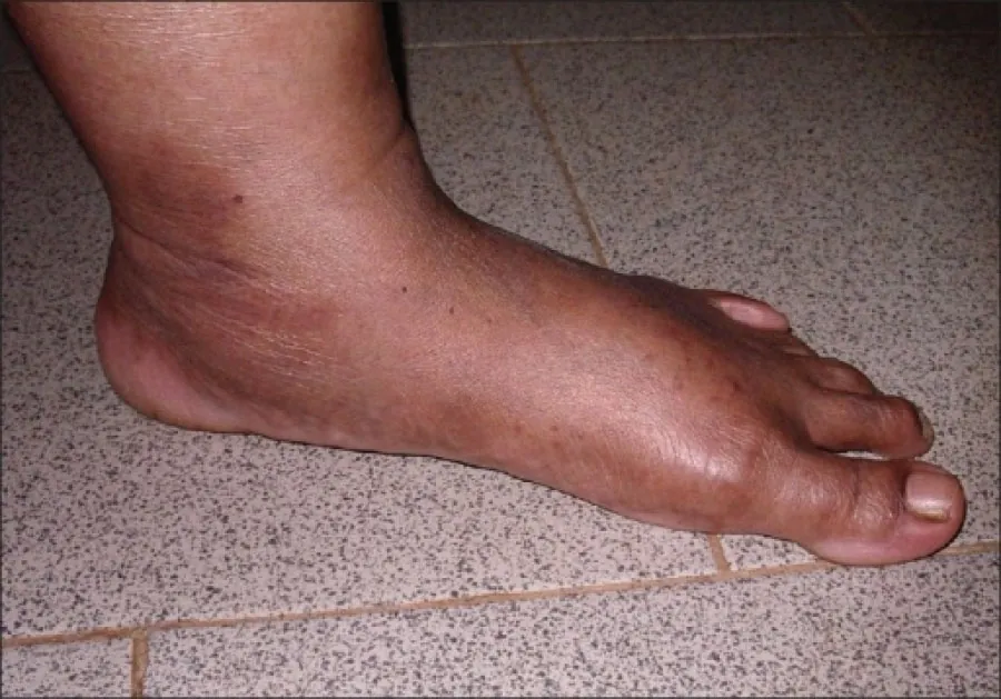 The image shows the side view of a person's bare foot on a tiled floor, exhibiting a condition known as flatfoot, characterized by the collapsing of the arch and the entire sole of the foot making contact with the ground.