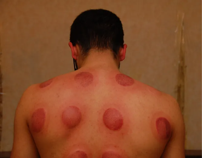 An individual’s back showing raised, circular red marks after a cupping session.