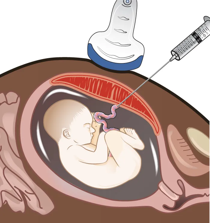 Image of pregnant person with fetus in utero. Ultrasound wand visible on abdomen. Large needle is being inserted into abdomen, going into the uterus into a blood vessel of the umbilical cord.