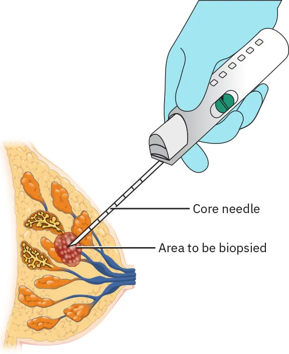 Image of a core needle being inserted into a mass in the breast that is to be biopsied.
