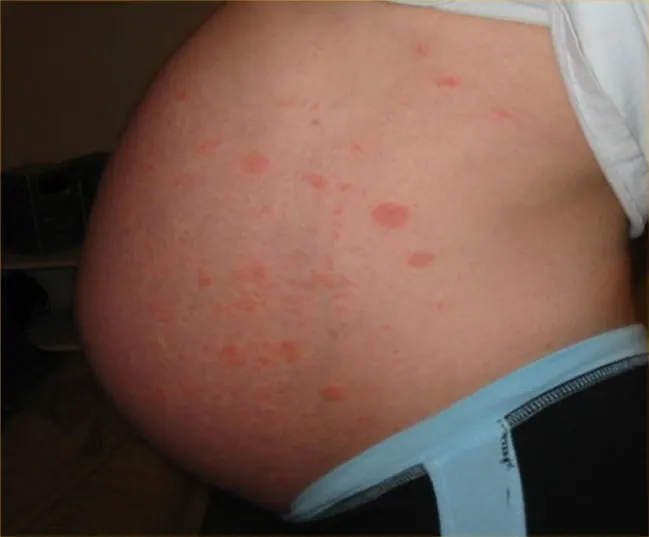 A photograph of a pregnant abdomen with Pruritic Urticarial Papules and Plaques of Pregnancy. The PUPPP appears as rash-like red marks on both sides of the navel.