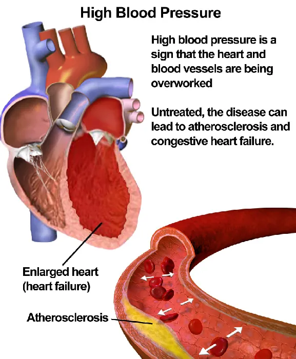 An illustrated cutaway of the heart of a patient with high blood pressure shows an enlarged heart muscle. An inset illustrates an artery with atherosclerosis and how that causes increased pressure on the artery walls as the blood goes through the artery.