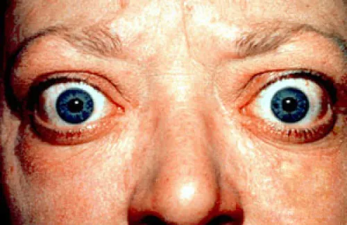A photo of two protruded eyes due to exophthalmos.