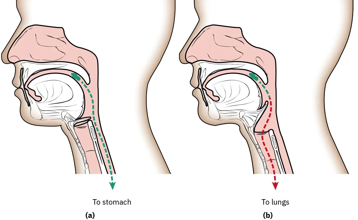 Diagram showing (a) normal swallowing with food traveling to stomach, (b) aspiration with food traveling to lungs.
