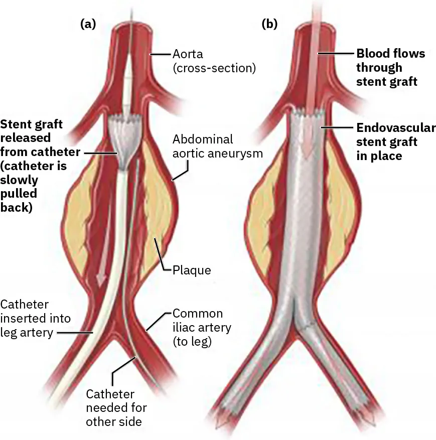 Diagram showing AAA repair, labeling Aorta (cross-section), Stent graft released from catheter (catheter is slowly pulled back), Abdominal aortic aneurysm, Plaque, Catheter inserted into leg artery, Common iliac artery (to leg), Catheter needed for other side, Blood flows through stent graft, and Endovascular stent graft in place.