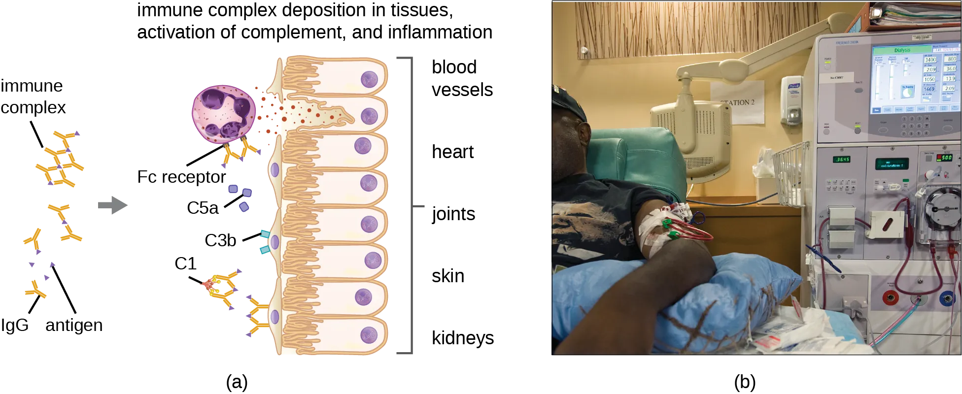 IgG binds to antigens and forms an immune complex made of multiple IgG and antigens. Immune complex deposition in tissues, activation of complement and inflammation. Image shows Immune complex binding to tissues, binding to C1, C3b and C5a binding to tissues. And IgG binding to neutrophils. Tissue damage is shown. B) Person on a dialysis machine.