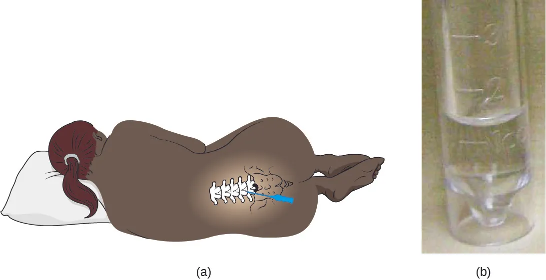 Figure a is a drawing of a person lying on their side with their back showing. An overlay drawing shows the location of the spine with an arrow pointing to between two vertebrae in the lower back. Figure b is a photograph of a covered test tube containing a clear liquid