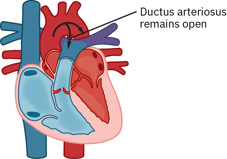 An illustrated cutaway of the heart muscle shows how blood flows when the ductus arteriosus remains open.