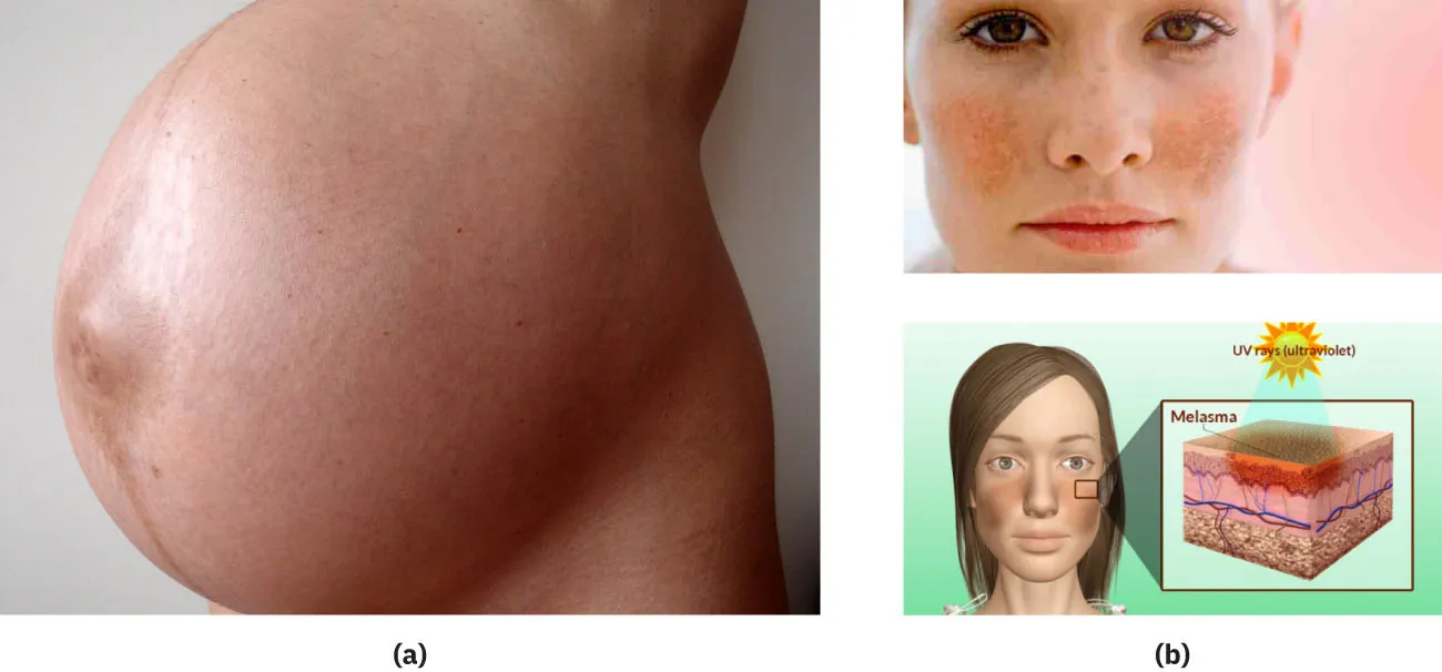 Images showing hyperpigmentation on the face and stomach. Image A shows a pregnant woman’s abdomen with hyperpigmentation in a line down the center. Image B is two images of a woman’s face with hyperpigmentation on the cheeks.