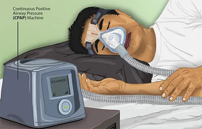 An image of a person’s face with a CPAP.