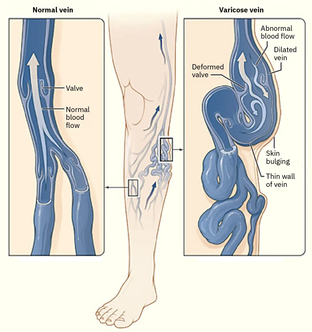 Diagram showing Normal vein and Varicose vein, Normal vein labeled with Valve and Normal blood flow, Varicose vein labeled with Deformed valve, Abnormal blood flow, Dilated vein, Skin bulging, and Thin wall of vein.