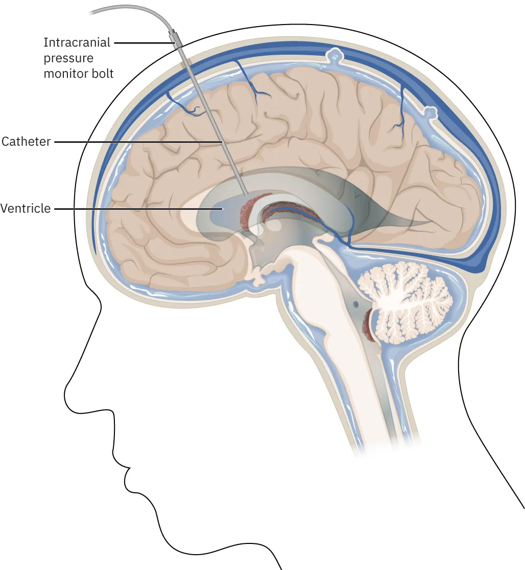 A diagram showing a ventriculostomy, labeling Intracranial pressure monitor bolt, Catheter, and Ventricle.