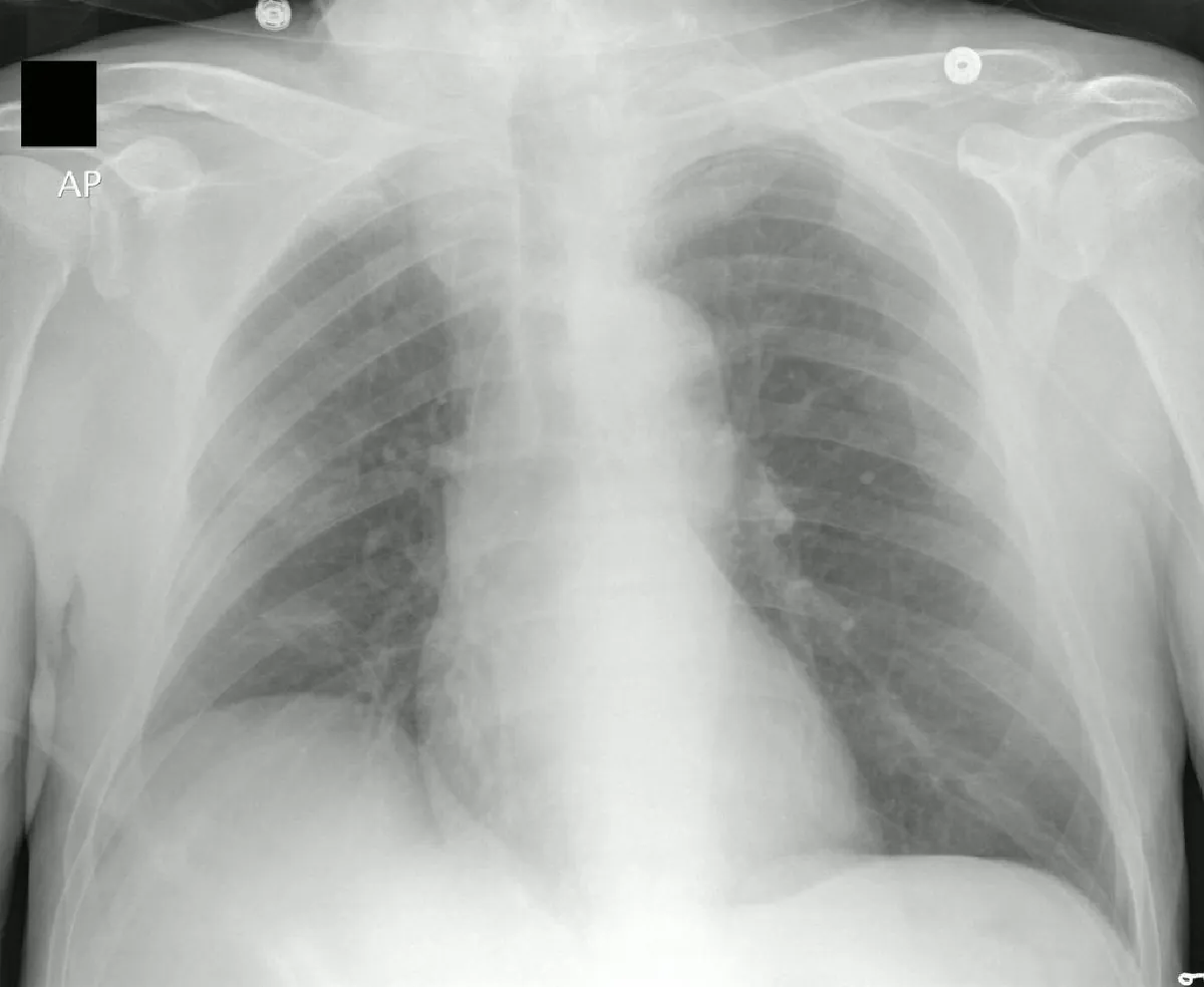 An X-ray image of a human chest with the tip of PICC line visible.