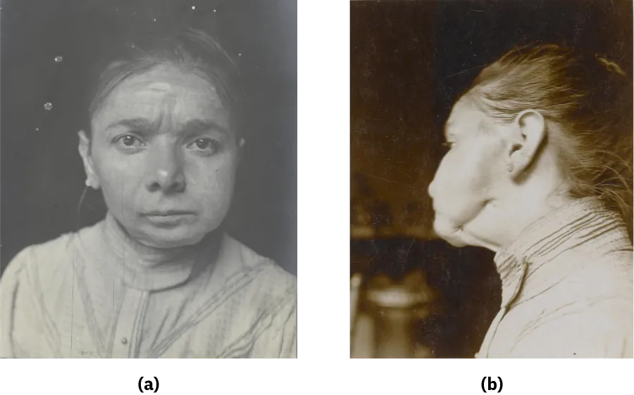Photograph a shows a woman staring directly into the camera. A large portion of her lower jaw is missing. Photograph b shows the same woman from the side and provides another view of her abnormally shaped jaw.