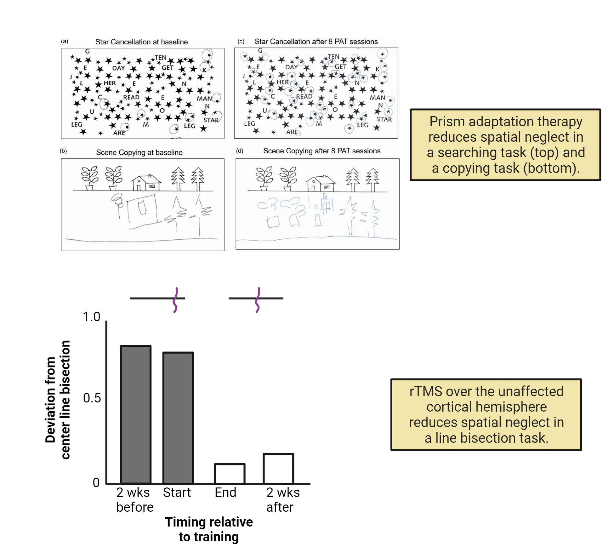 Top: Representative performance of neglect patients in a star cancellation task and scene copying task before and after prism adaptation training. Patients circle stars and copy objects on both sides of the image only after prism adaptation. Bottom: Representative performance of neglect patients in a line bisection task before and after rTMS over the unaffected cortical hemisphere. Bar graph shows deviation from center line bisection is high before training and low after.