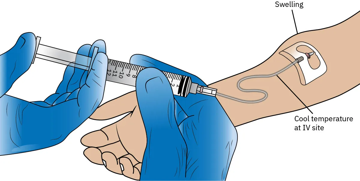An illustration shows a person’s arm and two gloved hands using a syringe. There is a tube from the syringe to the arm, and swelling at the site of injection.