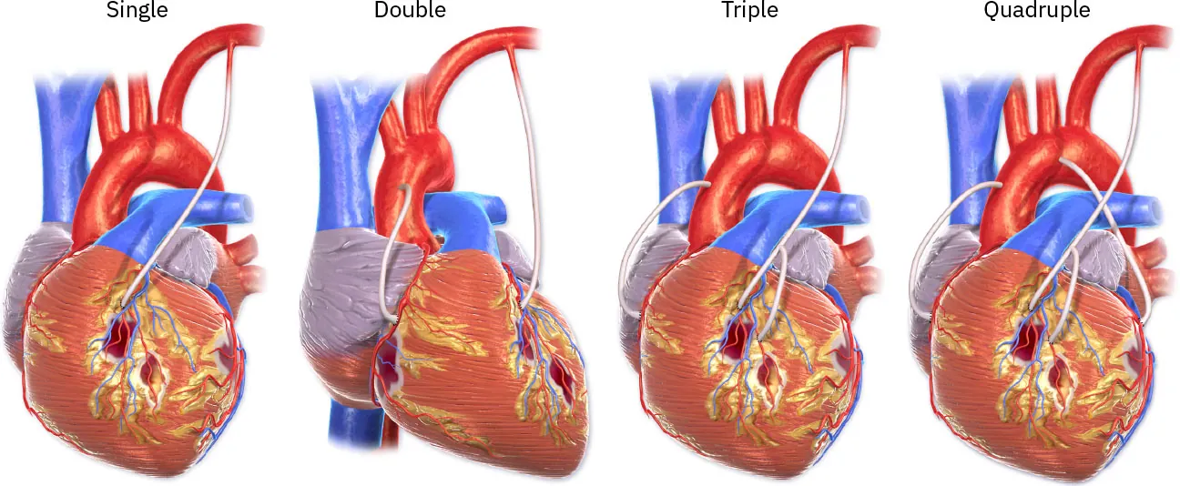 Diagrams showing single, double, triple, and quadruple coronary artery bypass grafts.