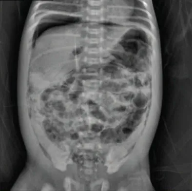 An x-ray image of an infant shows gas patterns within the intestinal wall characterized by dark, circular areas against the denser background of the abdomen. The patterns are irregularly distributed throughout the intestine.