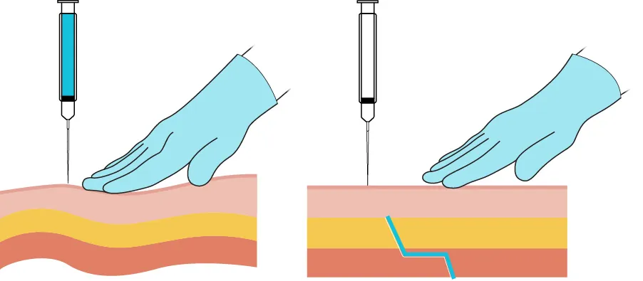 A two-part diagram showing how to perform the Z-track method