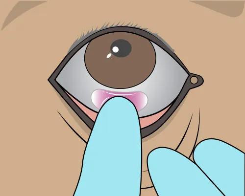 A close-up illustration of a provider pulling down a patient’s lower eyelid to insert an eye medication disk.