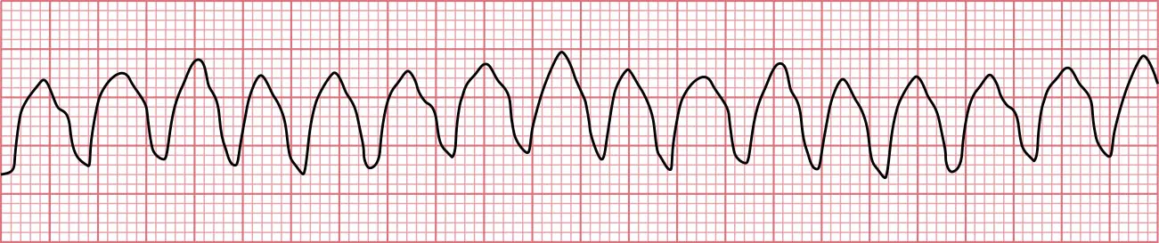 Sinus rhythm showing ventricular tachycardia with fast rate, no discernable P waves, and wide QRS.