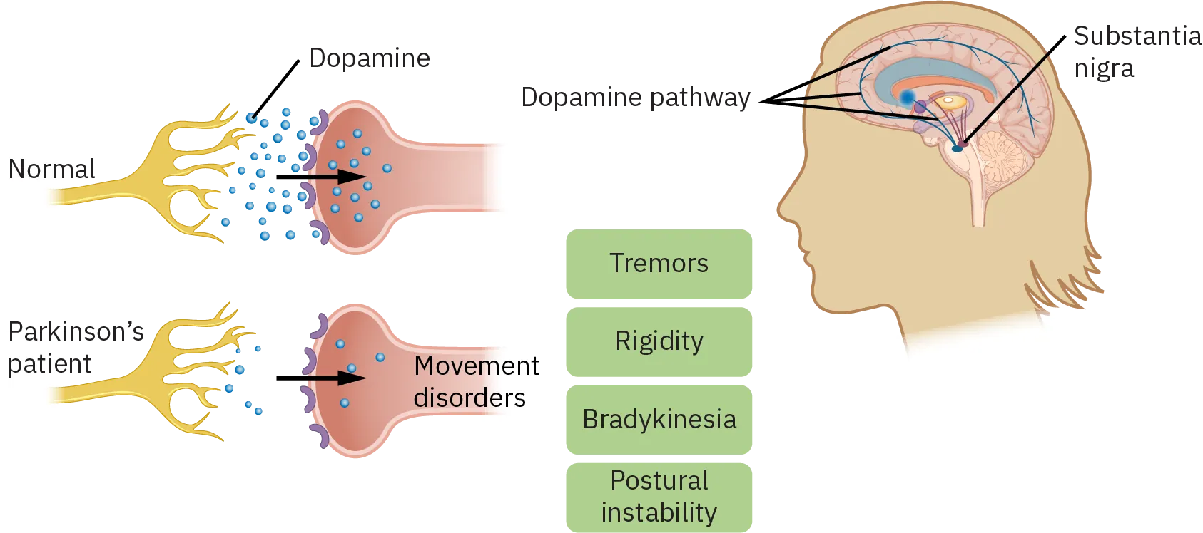 Normally, the correct amount of dopamine is received by the dopamine pathway in the brain. In a client with Parkinson's, a reduced amount of dopamine is produced, causing movement disorders such as tremors, rigidity, bradykinesia, and postural instability.