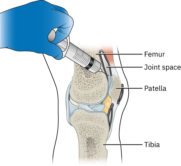Diagram of arthrocentesis procedure of the knee joint, labeling Femur, Joint space, Patella, and Tibia