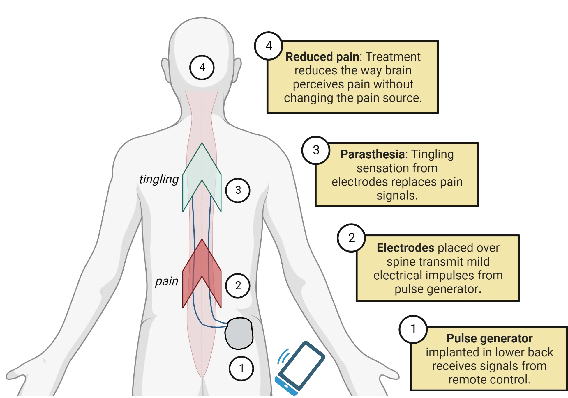 Diagram of human with pulse generator near their hip, wires extending up into the spine and arrows indicating flow upwards.