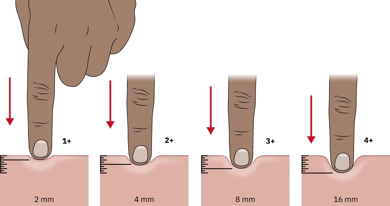 A color graphic showing a finger pressing into skin at different measurements. The first graphic shows a finger pressing into the skin and leaving a 2 millimeter depression. The second graphic shows the finger pressing into the skin and leaving a 4 millimeter depression. The third graphic shows the finger pressing into the skin and leaving a 6 millimeter depression. The fourth graphic shows the finger pressing into the skin and leaving an 8 millimeter depression.