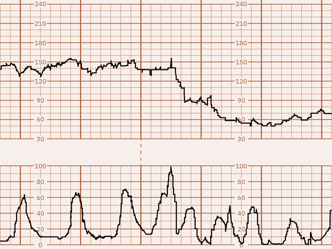 Fetal heart rate reading indicating prolonged decelerations.