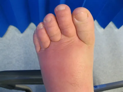A color photograph showing cellulitis toes