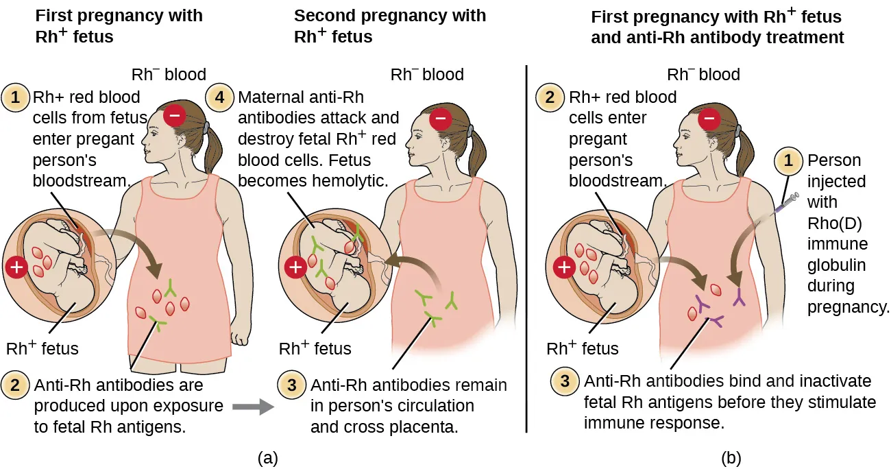 a) First pregnancy with Rh+ fetus resulting in healthy newborn. The diagram shows an Rh- person and an Rh+ fetus. Rh+ red blood cells cross the placenta into pregnant person’s circulation. This causes anti-Rh antibodies to be produced in the person upon exposure to fetal Rh antigens. The second pregnancy with Rh+ fetus results in hemolytic newborn. The diagram shows an Rh- person with an Rh+ fetus. Anti-Rh antibodies remain in pregnant person’s circulation from the first pregnancy and cross the placenta. Maternal anti-Rh antibodies attack and destroy fetal Rh+ red blood cells. b) First pregnancy with Rh+ fetus and anti-Rh antibody treatment resulting in healthy newborn The diagram shows an Rh- person and an Rh+ fetus. Rh+ red blood cells from the fetus cross placenta into pregnant person’s circulation. Anti-Rh antibodies (Rhogam) bind and inactivate fetal Rh antigens before they stimulate immune response in the pregnant person.