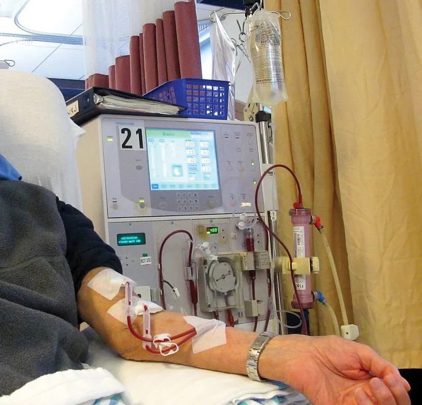 A photo shows a man’s arm connected to a dialysis machine. There are two blood-filled tubes conveying blood to and from his arm. The machine has a cylindrical filter, a mechanical circular pump, a bag of saline, and a display screen with various readings.